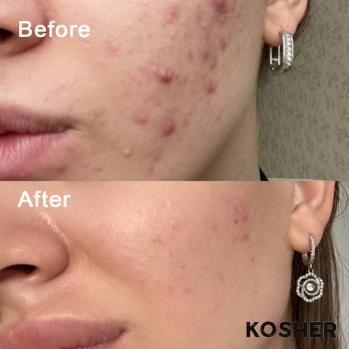 KOEC Salicylic Acid 2%